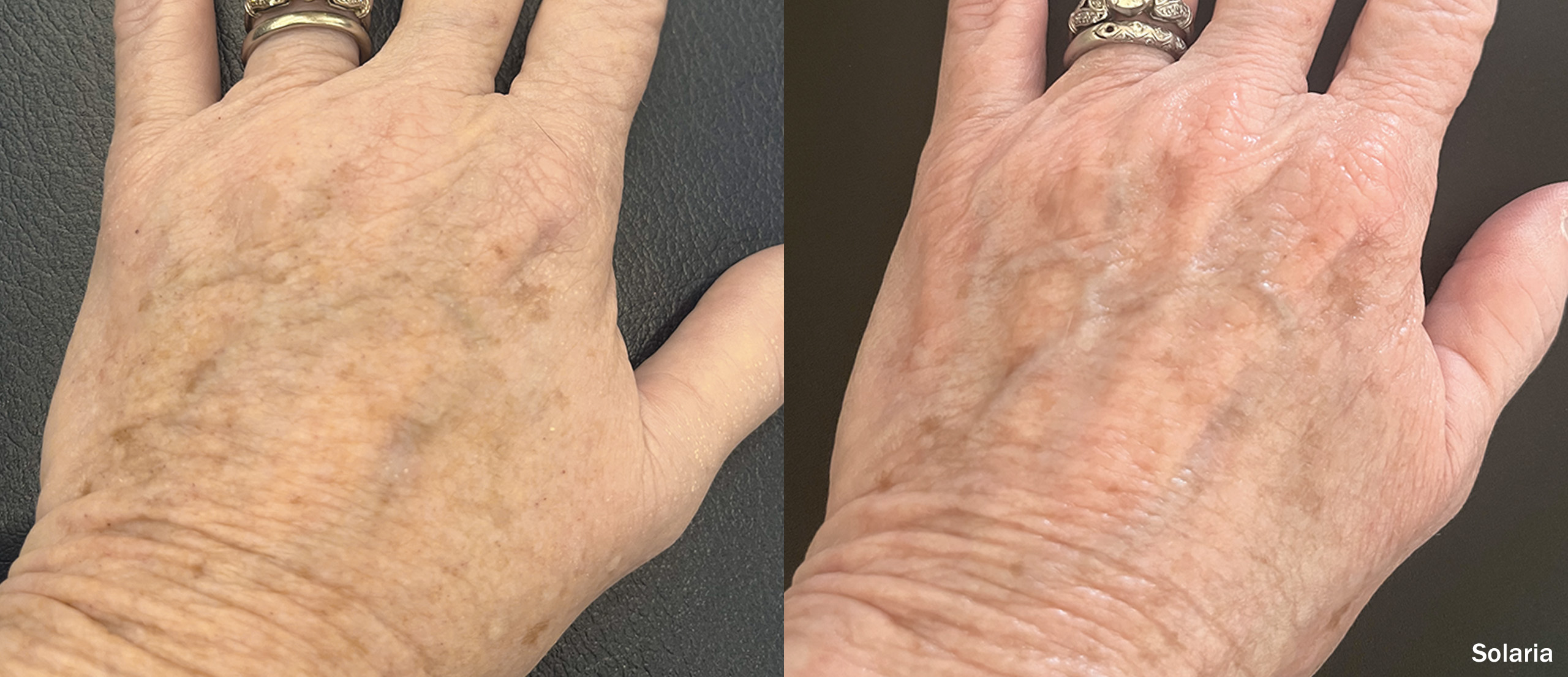 C02-Laser-INMD_Solaria_Hands_Female_LH-TM