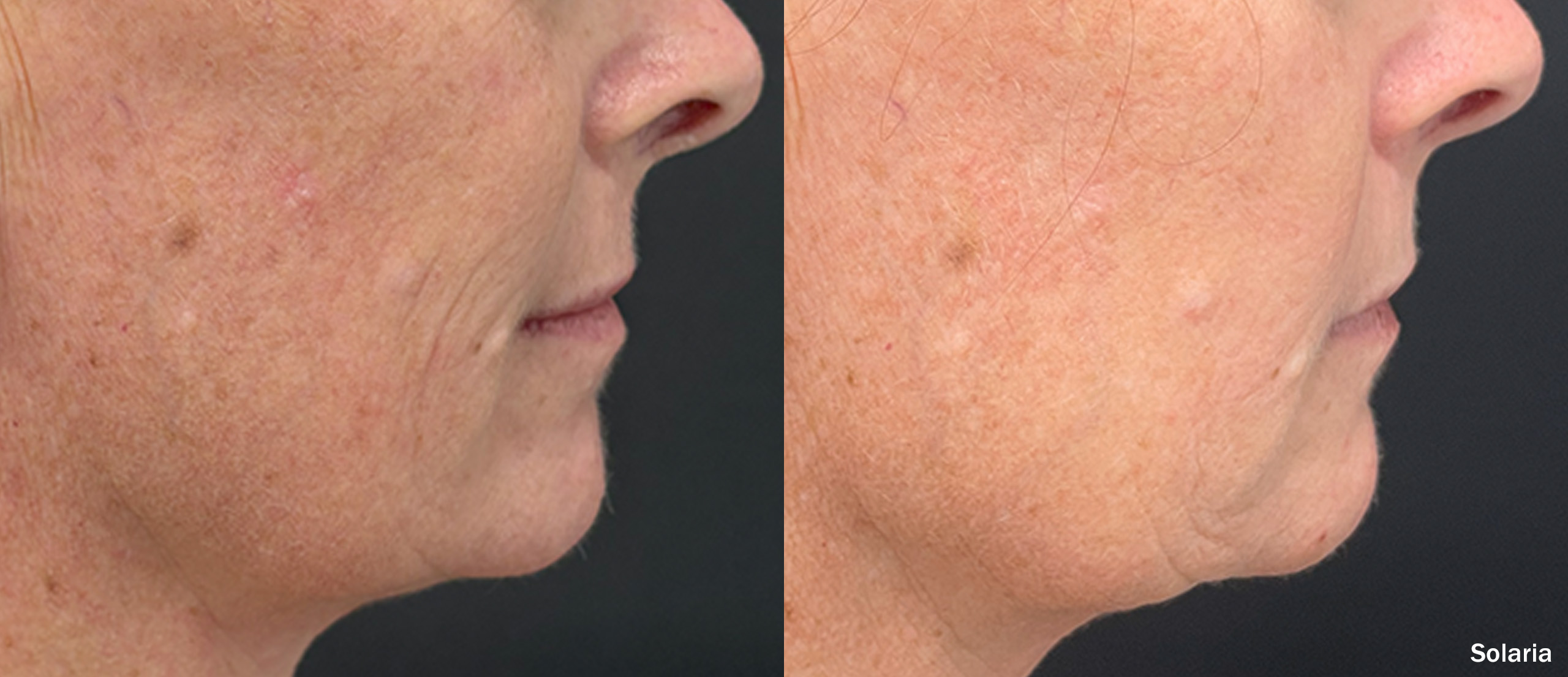 C02-Laser-Solaria_Face_Female_RS_Zoomx2-TM